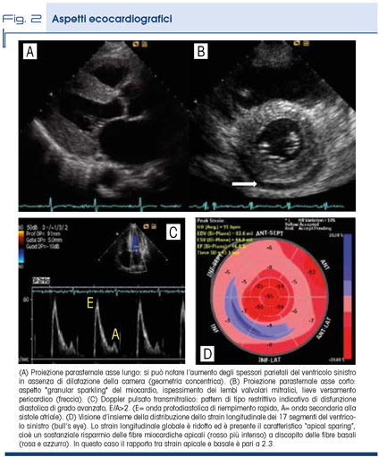 Fig. 2 - Aspetti ecocardiografici