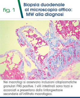 Fig 1 - Biopsia duodenale al microscopio ottico: MW alla diagnosi