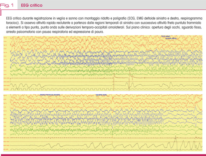 Fig. 1 EEG critico