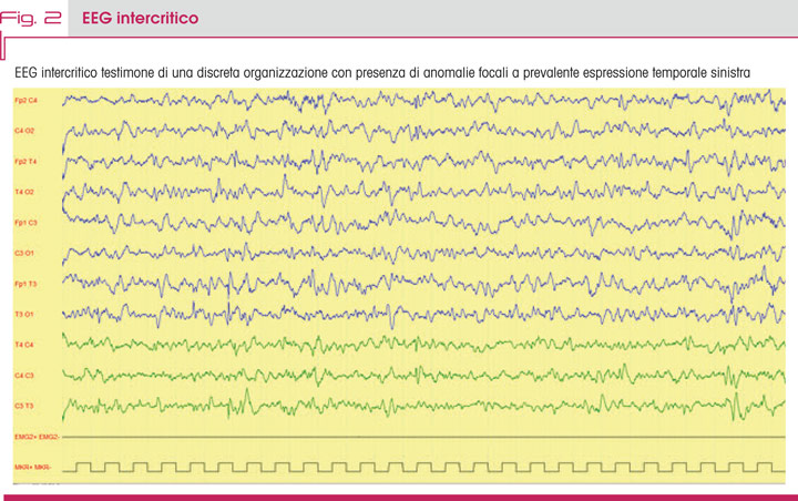 Fig. 2 EEG intercritico