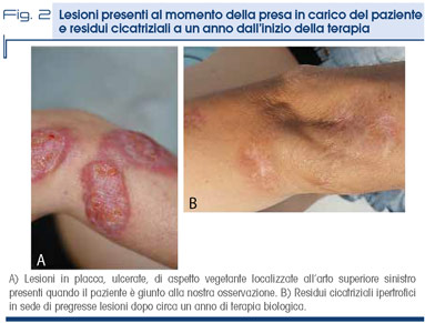 Fig. 2 - Lesioni presenti al momento della presa in carico del paziente  e residui cicatriziali a un anno dall’inizio della terapia