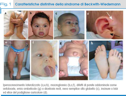 Fig. 1 Caratteristiche distintive della sindrome di Beckwith-Wiedemann