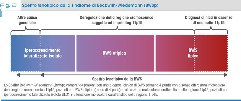 Fig. 2 Spettro fenotipico della sindrome di Beckwith-Wiedemann (BWSp)
