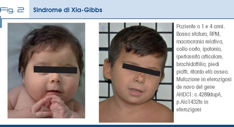 Fig. 2 Sindrome di Xia-Gibbs