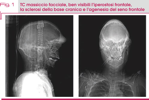 Fig. 1 TC massiccio facciale, ben visibili l’iperostosi frontale,  la sclerosi della base cranica e l’agenesia del seno frontale