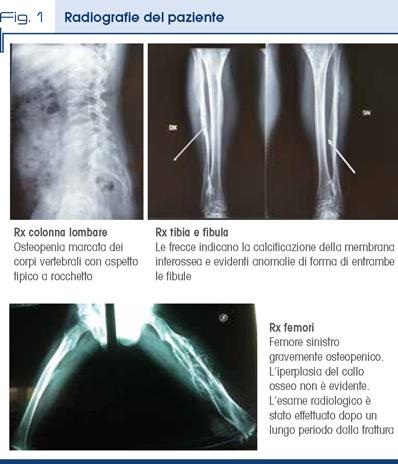 Fig. 1 - Radiografie del paziente