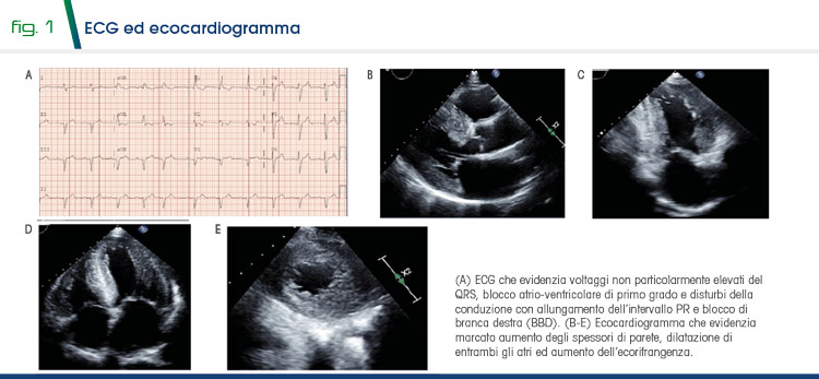 Fig 1 - ECG ed ecocardiogramma