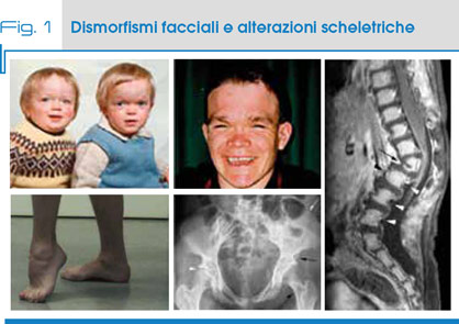 Fig. 1 Dismorfismi facciali e alterazioni scheletriche