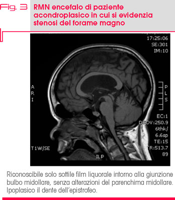 Fig. 3 RMN encefalo di paziente  acondroplasico in cui si evidenzia  stenosi del forame magno