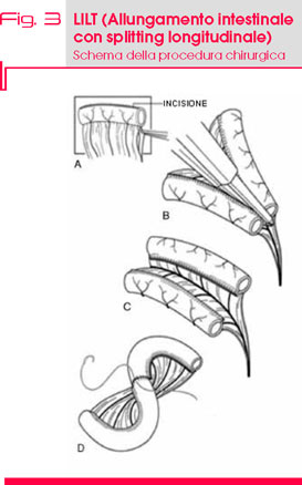 Fig. 3 LILT (Allungamento intestinale  con splitting longitudinale) Schema della procedura chirurgica