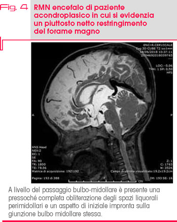 Fig. 4 RMN encefalo di paziente  acondroplasico in cui si evidenzia  un piuttosto netto restringimento  del forame magno