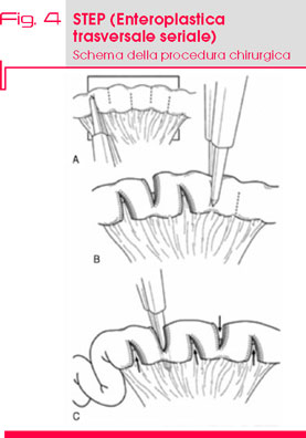 Fig. 4 STEP (Enteroplastica  trasversale seriale) Schema della procedura chirurgica