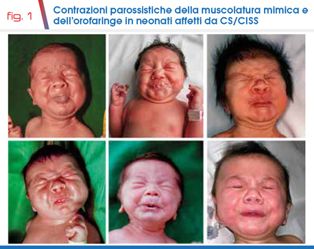 fig. 1 Contrazioni parossistiche della muscolatura mimica e dell’orofaringe in neonati affetti da CS/CISS