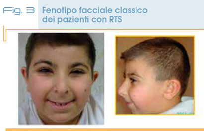 Fig. 3 Fenotipo facciale classico  dei pazienti con RTS