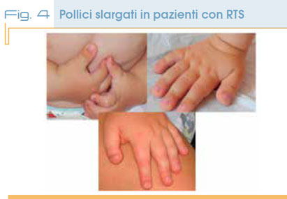 Fig. 4 Pollici slargati in pazienti con RTS