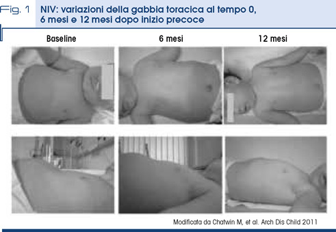 Fig. 1 - NIV: variazioni della gabbia toracica al tempo 0,  6 mesi e 12 mesi dopo inizio precoce