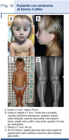 Fig. 3 - Paziente con sindrome  di Kenny-Caffey