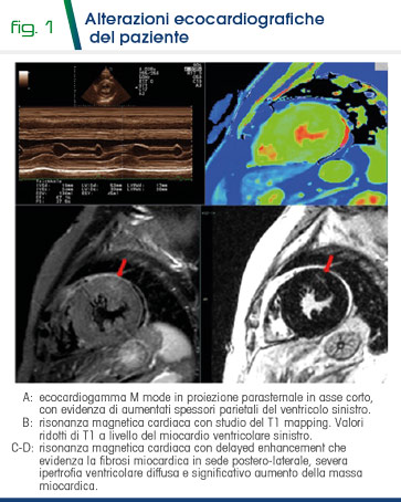 Fig 1 - Alterazioni ecocardiografiche  del paziente