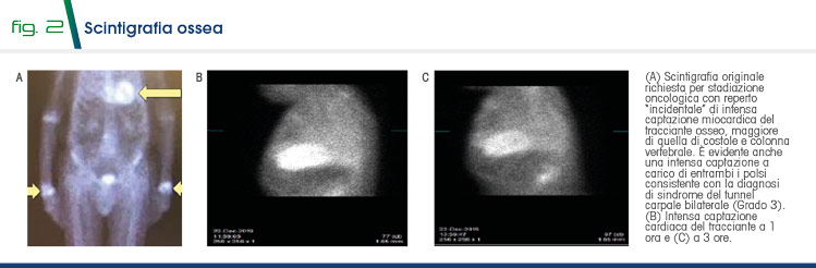 Fig 2 - Scintigrafia ossea