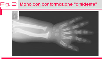 Fig. 2 Mano con conformazione “a tridente”