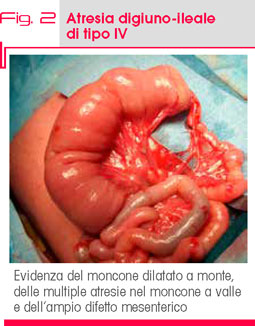 Fig. 2 Pollici ed alluci rivalutati nel  sospetto di RTS generato da WES