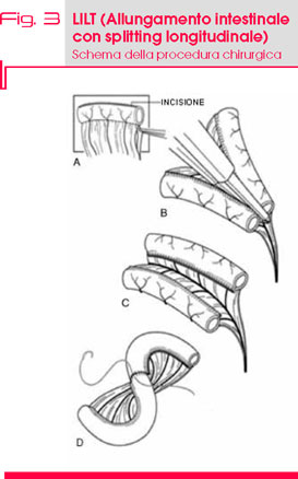 Fig. 3 Fenotipo facciale classico  dei pazienti con RTS